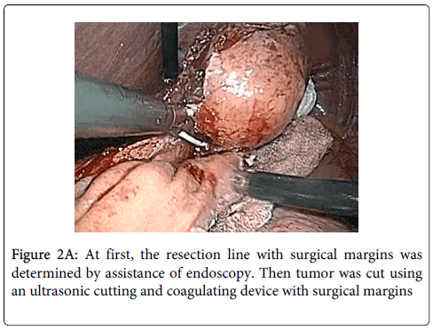 gastrointestinal-digestive-system-coagulating-device