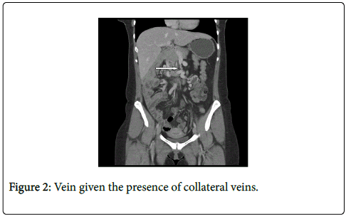 gastrointestinal-digestive-system-collateral-veins