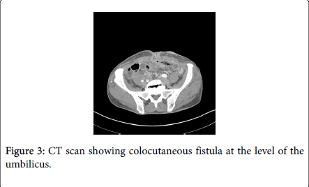 gastrointestinal-digestive-system-colocutaneous-fistula