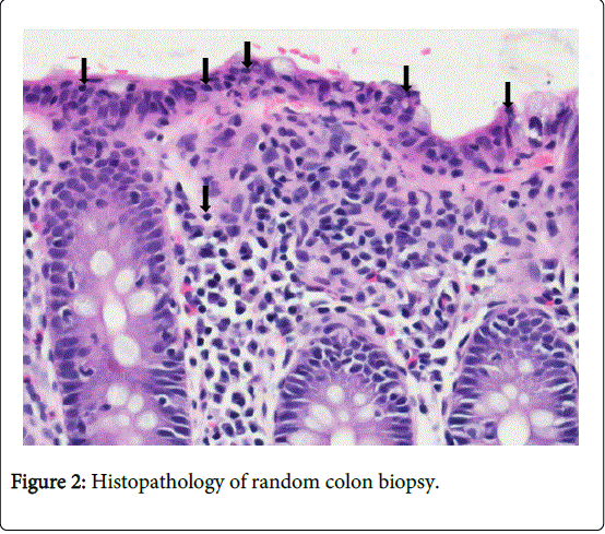gastrointestinal-digestive-system-colon-biopsy