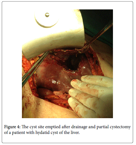 gastrointestinal-digestive-system-cyst-site-emptied