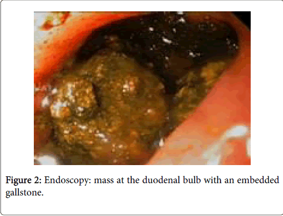 gastrointestinal-digestive-system-duodenal-bulb