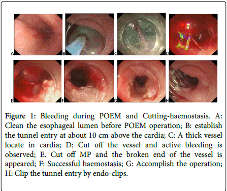 gastrointestinal-digestive-system-endo-clips