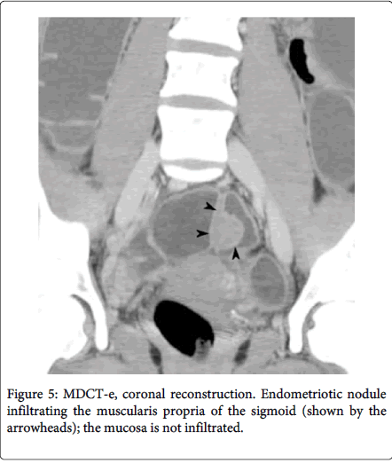 gastrointestinal-digestive-system-endometriotic-nodule