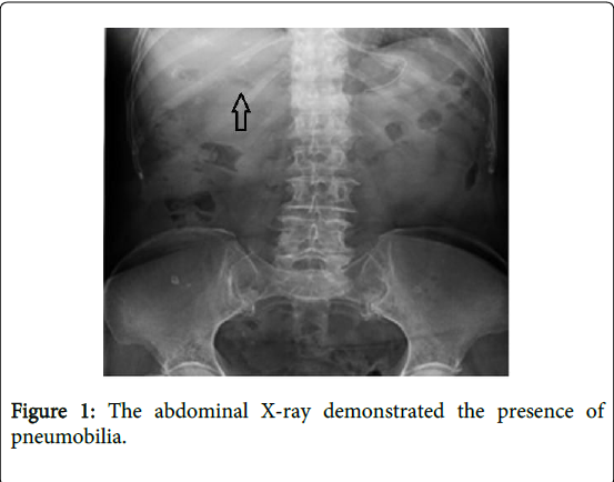 gastrointestinal-digestive-system-erythema-nodosum