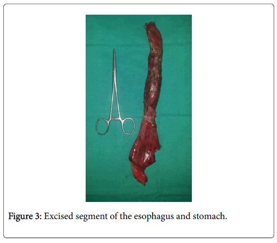 gastrointestinal-digestive-system-esophagus-stomach