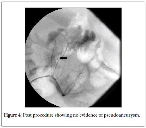 gastrointestinal-digestive-system-evidence-pseudoaneurysm