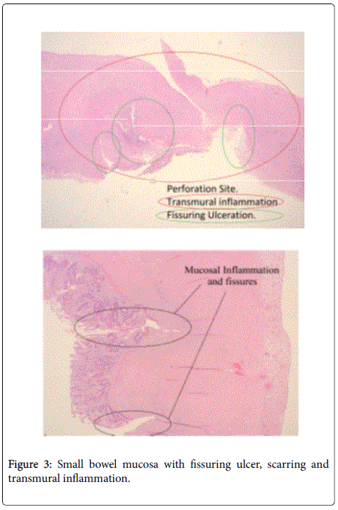 gastrointestinal-digestive-system-fissuring-ulcer