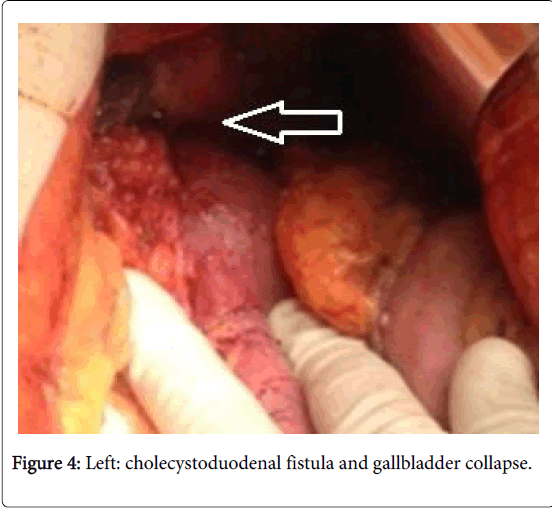 gastrointestinal-digestive-system-gallbladder-collapse