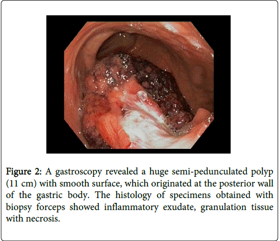 gastrointestinal-digestive-system-gastric-antrum