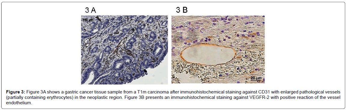 gastrointestinal-digestive-system-gastric-cancer