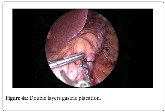 gastrointestinal-digestive-system-gastric-placation