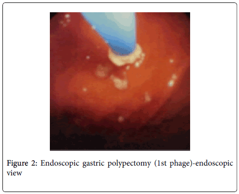 gastrointestinal-digestive-system-gastric-polypectomy