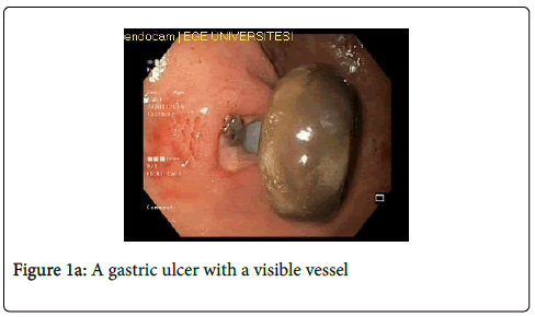 gastrointestinal-digestive-system-gastric-ulcer