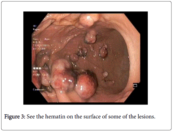 gastrointestinal-digestive-system-hematin-surface