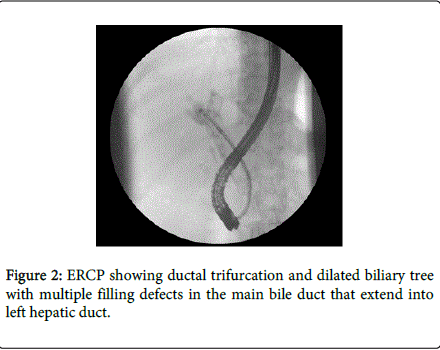 multiple biliary papillomatosis)