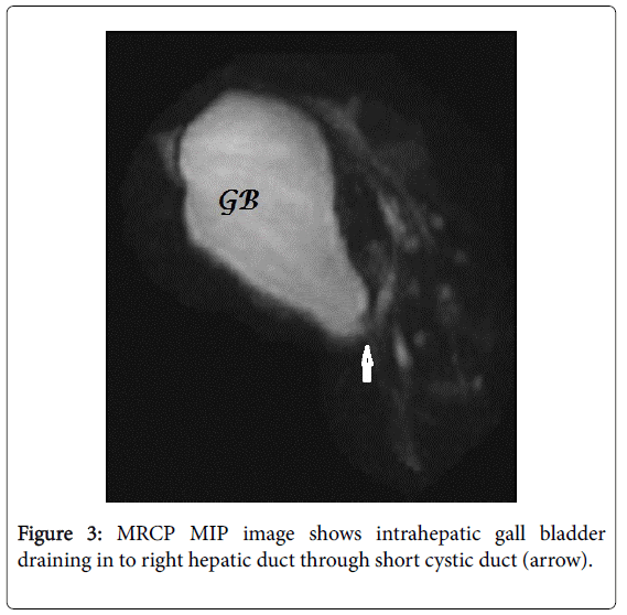 gastrointestinal-digestive-system-hepatic-duct
