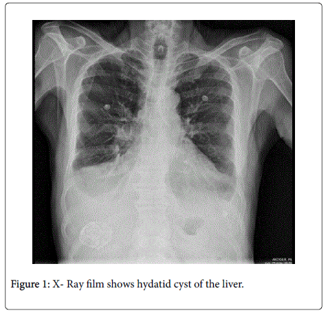 gastrointestinal-digestive-system-hydatid-cyst