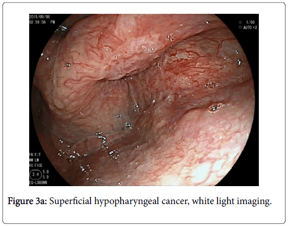 gastrointestinal-digestive-system-hypopharyngeal-cancer
