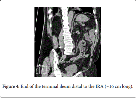 gastrointestinal-digestive-system-ileum-distal