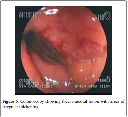gastrointestinal-digestive-system-irregular-thickening