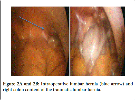gastrointestinal-digestive-system-lumbar-hernia