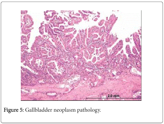 gastrointestinal-digestive-system-neoplasm-pathology