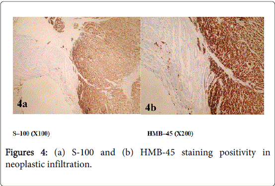 gastrointestinal-digestive-system-neoplastic-infiltration