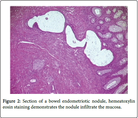 gastrointestinal-digestive-system-nodule-infiltrate