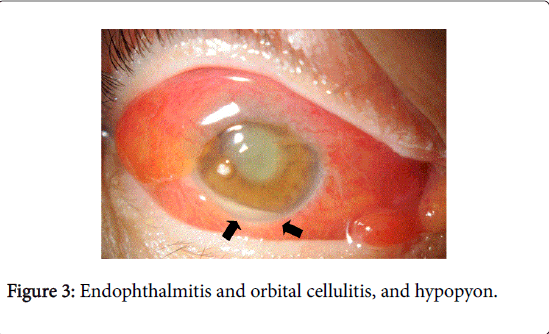 gastrointestinal-digestive-system-orbital-cellulitis