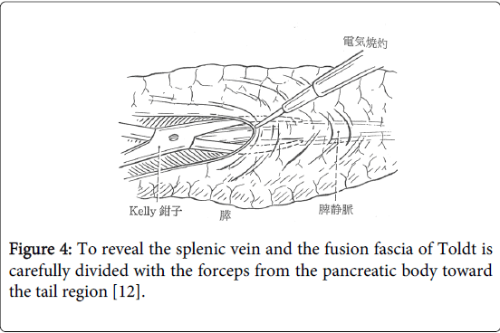 gastrointestinal-digestive-system-pancreatic-body