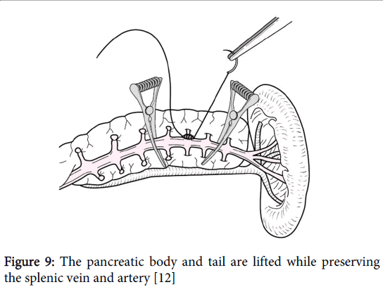 gastrointestinal-digestive-system-pancreatic-body