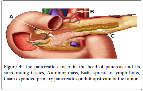 gastrointestinal-digestive-system-pancreatic-cancer