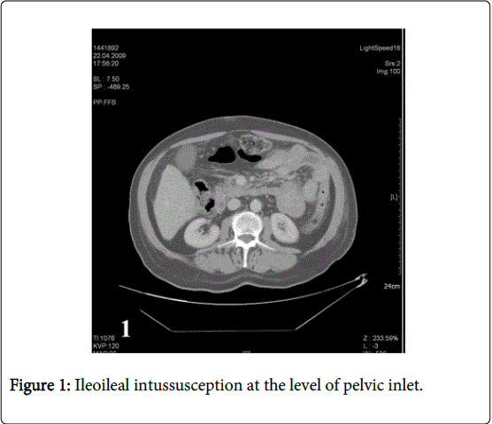 gastrointestinal-digestive-system-pelvic-inlet