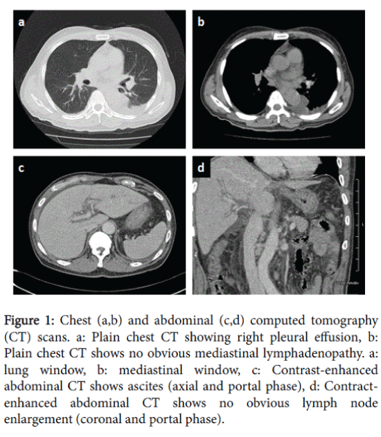 gastrointestinal-digestive-system-pleural-effusion