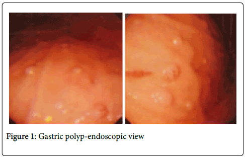 gastrointestinal-digestive-system-polyp-endoscopic