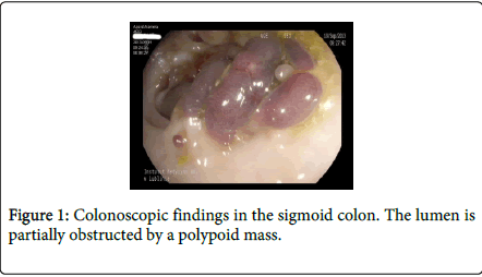 gastrointestinal-digestive-system-polypoid-mass