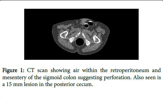 gastrointestinal-digestive-system-posterior-cecum