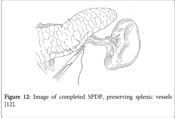 gastrointestinal-digestive-system-preserving-splenic