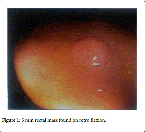 gastrointestinal-digestive-system-rectal-mass