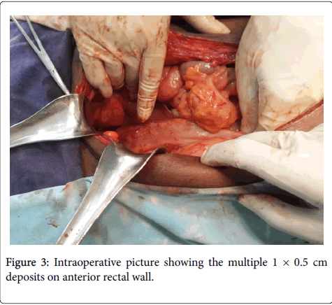 gastrointestinal-digestive-system-rectal-wall