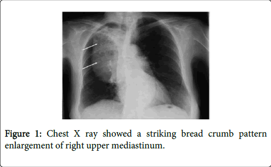 gastrointestinal-digestive-system-right-upper
