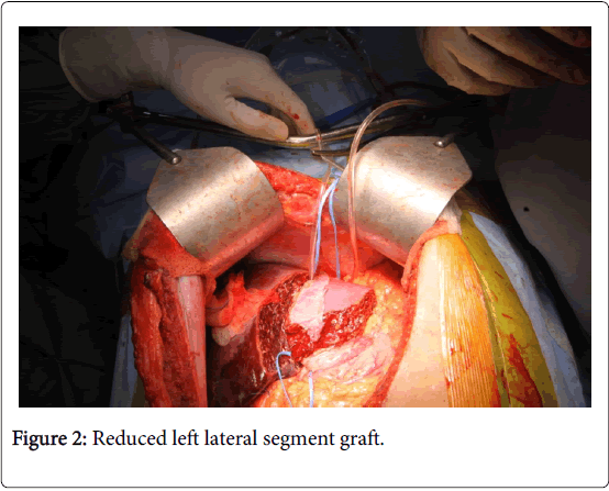 gastrointestinal-digestive-system-segment-graft