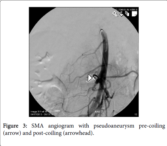 gastrointestinal-digestive-system-showing-pseudoaneurysm
