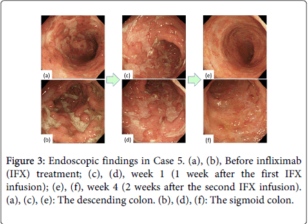gastrointestinal-digestive-system-sigmoid-colon