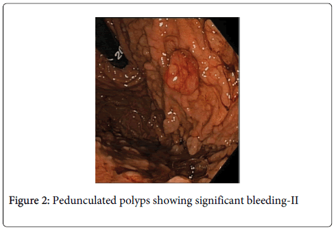 gastrointestinal-digestive-system-significant-bleeding