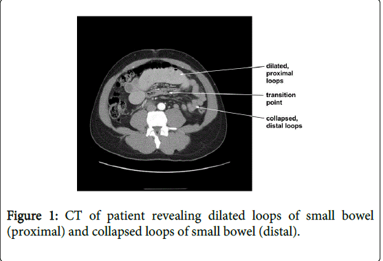 gastrointestinal-digestive-system-small-bowel
