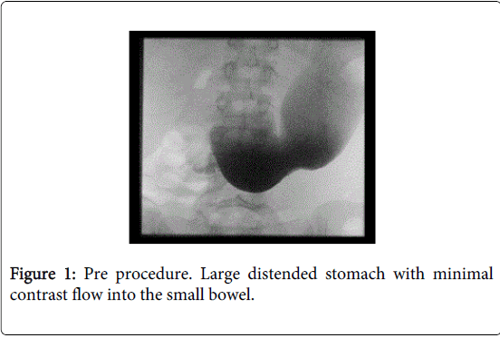 gastrointestinal-digestive-system-small-bowel