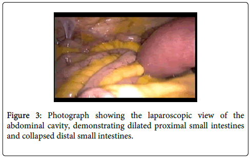 gastrointestinal-digestive-system-small-intestines