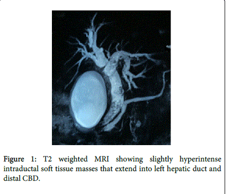 Multiple biliary papillomatosis - Cancer pulmonar simptome diagnostic